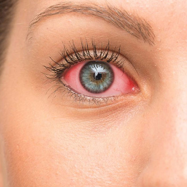 Dry Eye Close Up